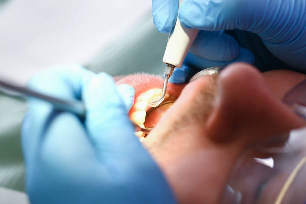 Best Emergency Dental Care for Sports Injuries in Montpelier, VT